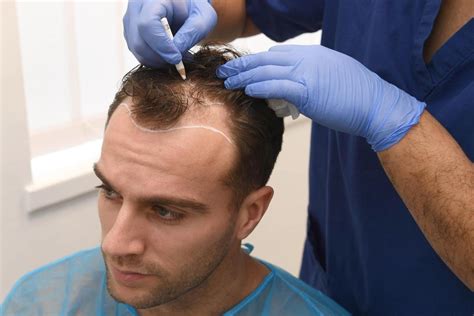 best clinic hair transplant turkey